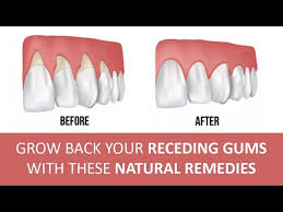 home remes for gum disease