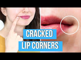 how to cure ed lip corners