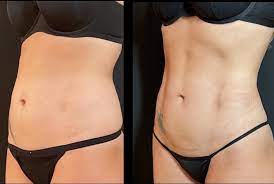 liposuction vs tummy tuck neinstein