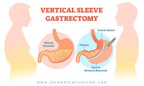 That said, a 2019 article in webmd estimated the cost to be $20,000 to $25,000. How Much Does Gastric Sleeve Cost Gastric Sleeve Surgery Cost
