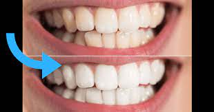 Everyday, things such as eating various foods, drinking coffee or even drinking wine can cause staining on our teeth. These 7 Hacks Will Naturally Whiten Your Teeth In No Time