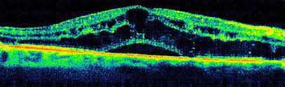 macular edema retina ophthalmology