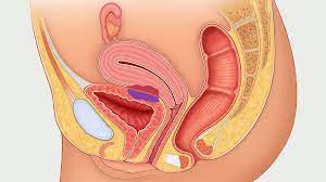 A disorder, typically leading to discomfort and dysmenorrhea, that's characterized by the abnormal event of useful endometrial muscle outside of the uterus.; What Is Deep Infiltrating Endometriosis Die Causes Symptoms And Treatment Everyday Health