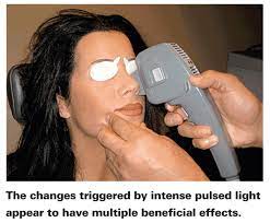 intense pulsed light for treating dry eye