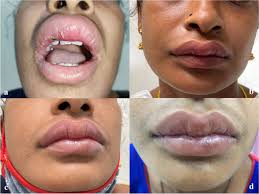 granulomatous cheilitis of miescher a