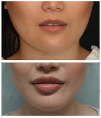beautiful upper lip lifts without scars
