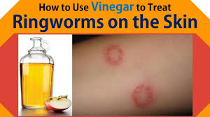 vinegar to treat ringworms on the skin