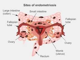 Endometriosis can only be definitively confirmed via minimally invasive surgery known as laparoscopy, where we actually look inside under anesthesia using a small telescope to visualize. Endometriosis