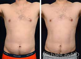 male body contouring photo gallery