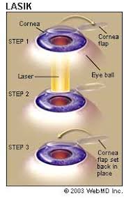 I did a lot of research before i had my. Lasik Laser Eye Surgery Procedure Risks Recovery And Side Effects