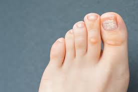 the white patches on your toenails