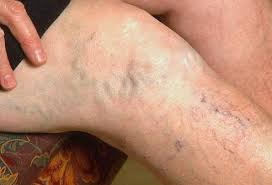 potential dangers of varicose veins