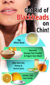 blackheads on chin home remes to