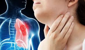 Do enlarged lymph nodes always mean cancer? Lung Cancer Symptoms Signs Of A Tumour Include Having Swollen Glands On Your Neck Express Co Uk