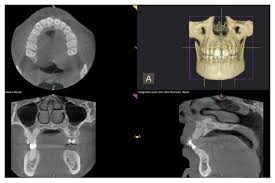 cbct can impact implant placement
