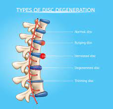 herniated discs can be a real pain in