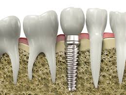 tooth replace it with a dental implant