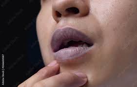 cyanotic lips or central cyanosis in