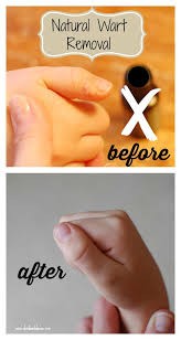 natural effective wart removal