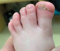 con defect of the toenail