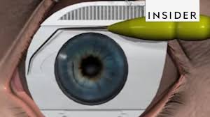 Some eye conditions make lasik not a good option. How Lasik Eye Surgery Is Performed Youtube