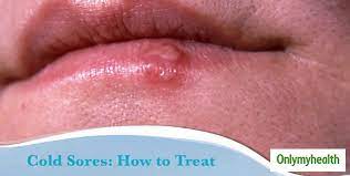 fever blisters or cold sores