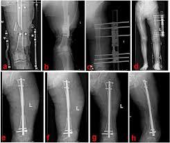 segmental fem bone defects