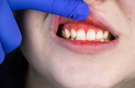 how to stop dental bleeding edmonton