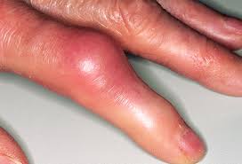 Image result for joint pain in fingers