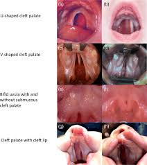 cleft palate morphology genetic