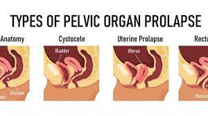 what s a pelvic organ prolapse the