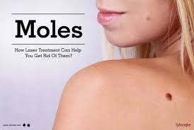 moles how laser treatment can help