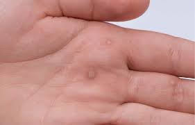 warts common types and best treatment