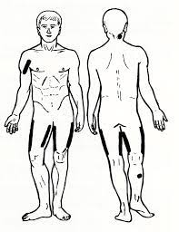 maniting ileocecal valve syndrome