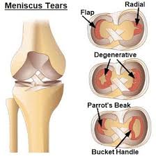 stiff knee causes treatment knee