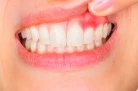 Oral hygiene is a key to solve dental issues; Know The 4 Stages Of Gum Disease Royal Oak Family Dental