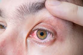 red eyes causes treatments when to