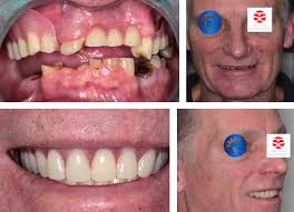 Free dental implants for low income uk. Case Studies Testimonials Patient Gallery Soni Dental Implants