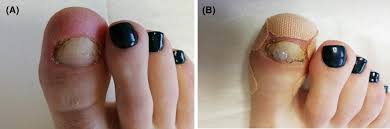 disappearing nail bed caused by trauma