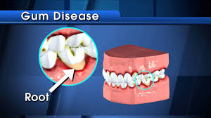 cavities mouthhealthy health