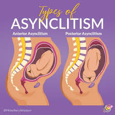 types of asynism midwifery wisdom