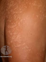 tinea versicolor treatment creams