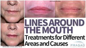 treatments for lines around the mouth