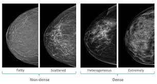 What Is Breast Density And Why Is It Important To Discuss