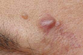 cyst lipoma removal skin care center