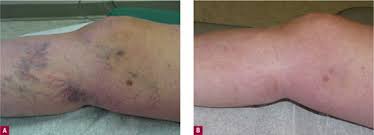 Sclerotherapy Of Small Veins Plastic Surgery Key