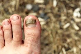 a bruised toenail or an infection
