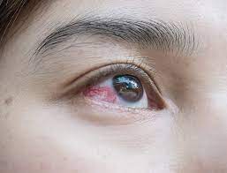 broken blood vessel in eye phoenix