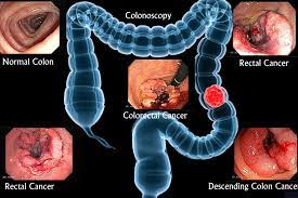 colorectal cancer notes on cyber