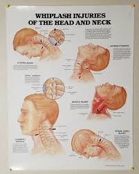 Whiplash Injuries Of Head Neck Wall Chart Medical Doctor